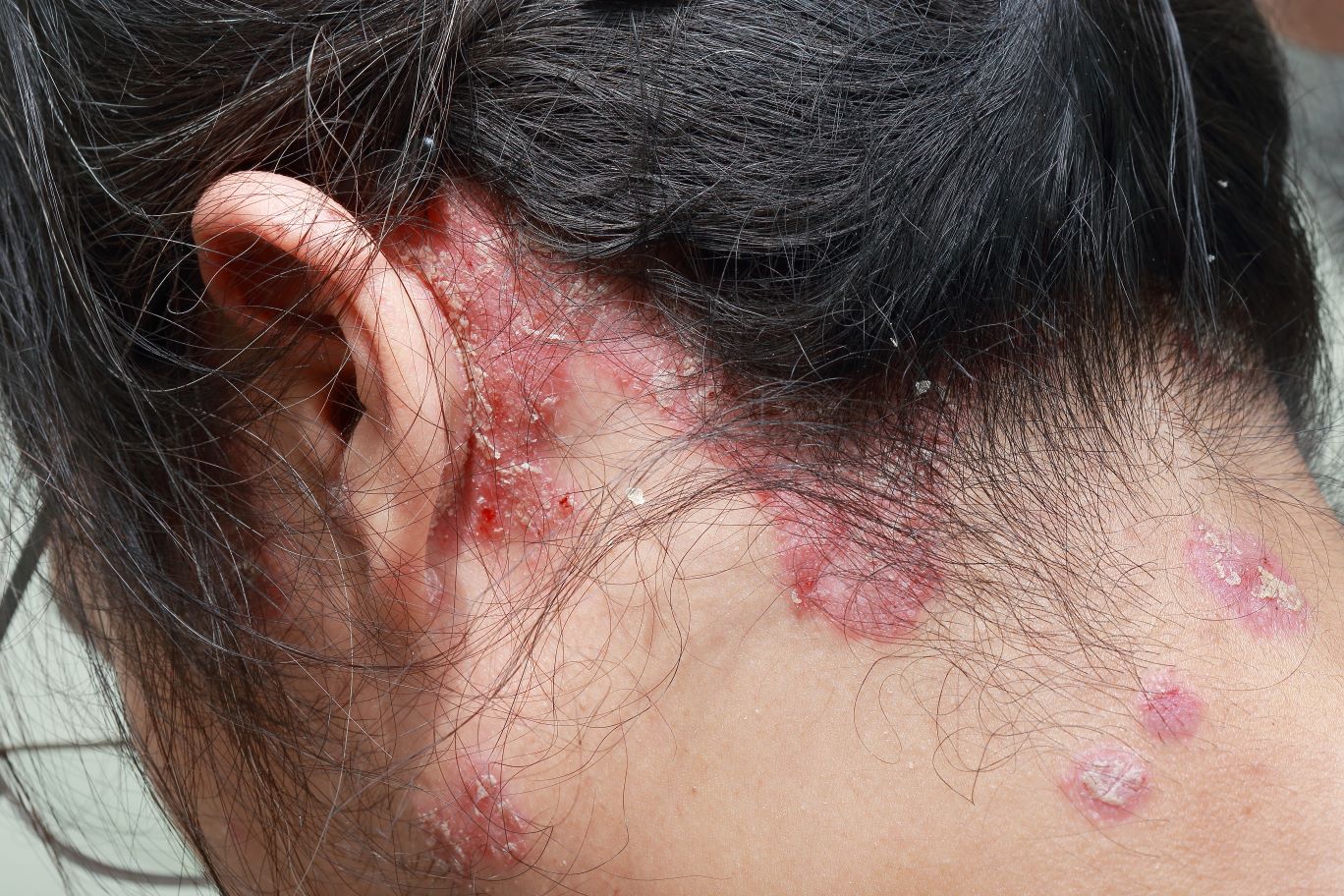 A head with signs of scalp psoriasis